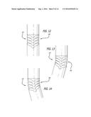 BI-LATERAL ENDOBRONCHIAL SUCTIONING DEVICE AND MEDICAL SUCTIONING SYSTEM     FOR INTUBATED PATIENTS diagram and image