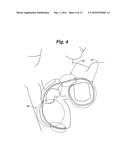 Method for Detecting and Localizing Insulation Failures of Implantable     Device Leads diagram and image