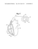 Method for Detecting and Localizing Insulation Failures of Implantable     Device Leads diagram and image