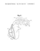 Method for Detecting and Localizing Insulation Failures of Implantable     Device Leads diagram and image