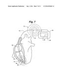 Method for Detecting and Localizing Insulation Failures of Implantable     Device Leads diagram and image