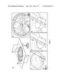 REVERSING COGNITIVE-MOTOR IMPAIRMENTS IN PATIENTS HAVING A     NEURO-DEGENERATIVE DISEASE USING A COMPUTATIONAL MODELING APPROACH TO     DEEP BRAIN STIMULATION PROGRAMMING diagram and image