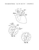 Intravascular Electrode System and Method diagram and image