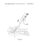 APPARATUS AND METHODS FOR SEALING A VASCULAR PUNCTURE diagram and image