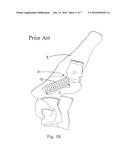 METHOD AND SYSTEM FOR TRANS-LAMINA SPINAL FIXATION diagram and image