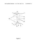 PATIENT-SPECIFIC INTRALUMINAL IMPLANTS diagram and image