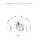 PROSTHETIC HEART VALVES HAVING FIBER REINFORCED LEAFLETS diagram and image