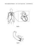 MEDICAL DEVICE FOR TREATING A HEART VALVE INSUFFICENCY diagram and image