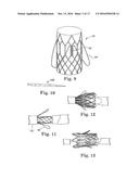 Stent for Prosthetic Heart Valves diagram and image