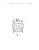 Stent for Prosthetic Heart Valves diagram and image