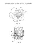 Stent for Prosthetic Heart Valves diagram and image