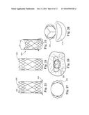 Stent for Prosthetic Heart Valves diagram and image