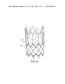 Stent for Prosthetic Heart Valves diagram and image