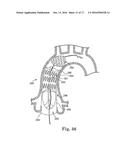 Stent for Prosthetic Heart Valves diagram and image