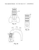 Stent for Prosthetic Heart Valves diagram and image