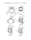 Stent for Prosthetic Heart Valves diagram and image