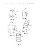 Stent for Prosthetic Heart Valves diagram and image