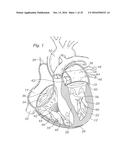 SURGICAL HEART VALVES ADAPTED FOR POST IMPLANT EXPANSION diagram and image