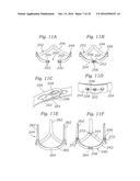 SURGICAL HEART VALVES ADAPTED FOR POST IMPLANT EXPANSION diagram and image