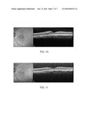 SYSTEM AND PROCESS FOR RETINA PHOTOTHERAPY diagram and image