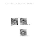 Ocular Insert Composition of a Semi-Crystalline or Crystalline     Pharmaceutically Active Agent diagram and image