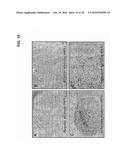 METHOD FOR TREATING PANCREATITIS WITH MESENCHYMAL STEM CELLS diagram and image