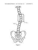 Method of Treating Scoliosis Using a Biological Implant to scoliosis diagram and image