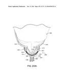 PATIENT INTERFACE AND METHOD FOR MAKING SAME diagram and image