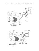 PATIENT INTERFACE AND METHOD FOR MAKING SAME diagram and image