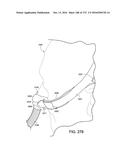 PATIENT INTERFACE AND METHOD FOR MAKING SAME diagram and image