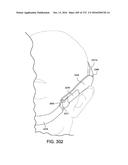 PATIENT INTERFACE AND METHOD FOR MAKING SAME diagram and image