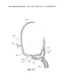 PATIENT INTERFACE AND METHOD FOR MAKING SAME diagram and image