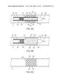 ADJUSTABLE-LENGTH DRUG DELIVERY BALLOON diagram and image