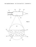 ADJUSTABLE-LENGTH DRUG DELIVERY BALLOON diagram and image