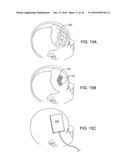 SYSTEMS, METHODS AND DEVICES FOR A SKULL/BRAIN INTERFACE diagram and image