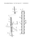 BRAIDED LEAD WITH EMBEDDED FIXATION STRUCTURES diagram and image