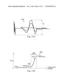 IPG CONFIGURED TO DELIVER DIFFERENT PULSE REGIMES TO DIFFERENT LEADS FOR     PUDENDAL NERVE STIMULATION diagram and image