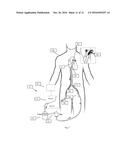 System and Methods for Removing Undesirable Material within a Circulatory     System Utilizing during a Surgical Procedure diagram and image