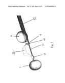 SUBSTANTIALLY RIGID AND STABLE ENDOLUMINAL SURGICAL SUITE FOR TREATING A     GASTROINTESTINAL LESION diagram and image