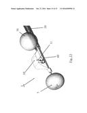 SUBSTANTIALLY RIGID AND STABLE ENDOLUMINAL SURGICAL SUITE FOR TREATING A     GASTROINTESTINAL LESION diagram and image