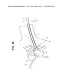 RIGID ENDOSCOPE FOR PROSTATE BIOPSY AND TREATMENT INSTRUMENT diagram and image