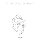 ELECTRODE CATHETER FOR ABLATION PURPOSES AND RELATED METHOD THEREOF diagram and image