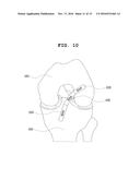 SYSTEM AND METHOD FOR SIMULATING RECONSTRUCTIVE SURGERY OF ANTERIOR     CRUCIATE LIGAMENT USING MEDICAL IMAGES diagram and image