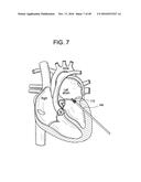 PROSTHETIC VALVES AND RELATED INVENTIONS diagram and image