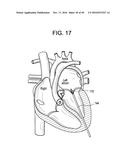 PROSTHETIC VALVES AND RELATED INVENTIONS diagram and image