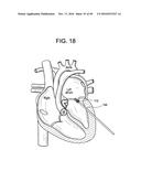 PROSTHETIC VALVES AND RELATED INVENTIONS diagram and image