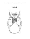 PROSTHETIC VALVES AND RELATED INVENTIONS diagram and image