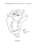 INTERVERTEBRAL DEVICE AND METHODS OF USE diagram and image