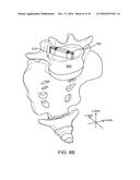 INTERVERTEBRAL DEVICE AND METHODS OF USE diagram and image