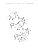 Intragastric Balloon for Treating Obesity diagram and image